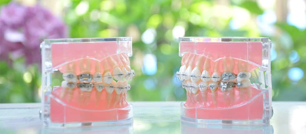 歯列矯正治療のリスクについて